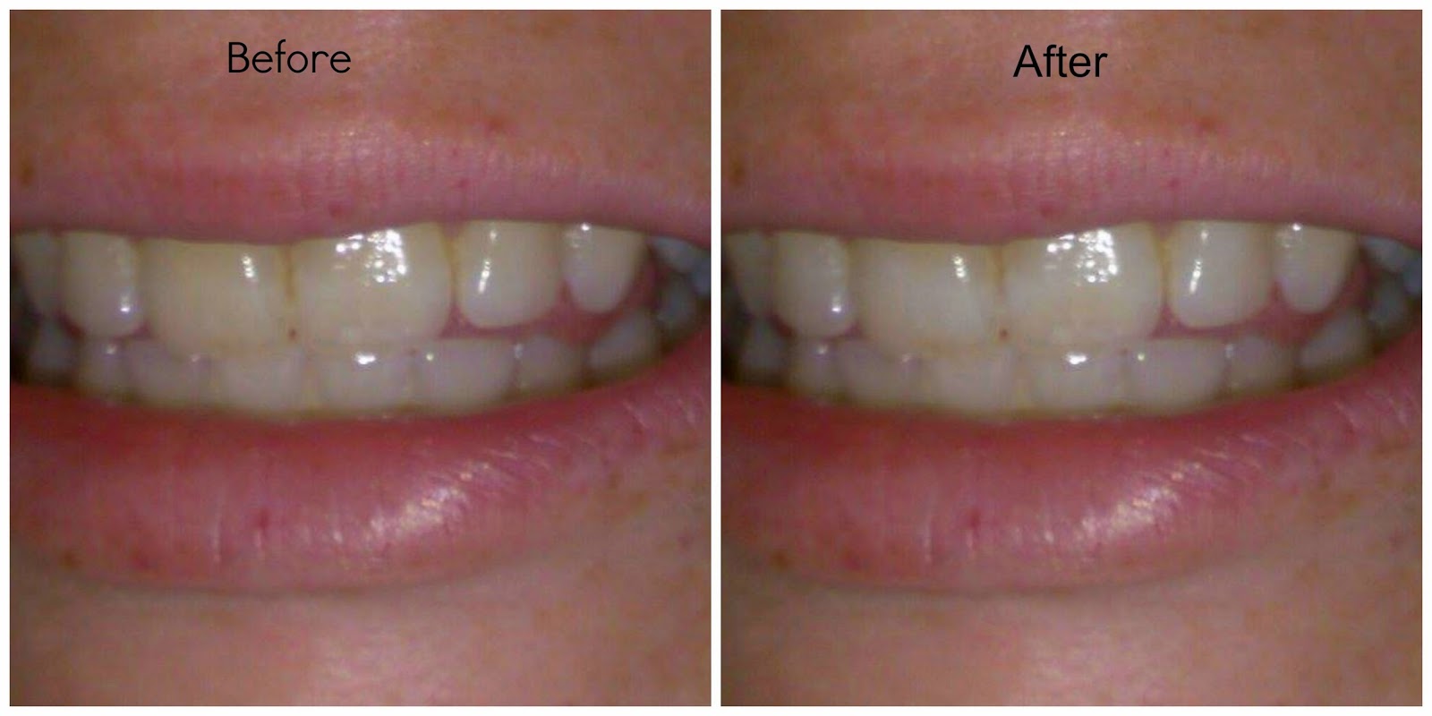 Allure by Amy A Beautiful You Dr.Song Tooth Whitening System