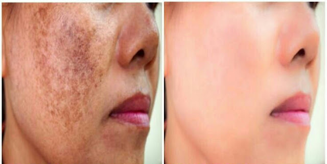 Super lifestyle tips: Hyperpigmentation: How to get Rid of