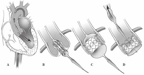 Transcatheter aortic valve replacement