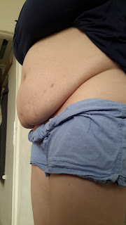 Pics of my Endo Belly