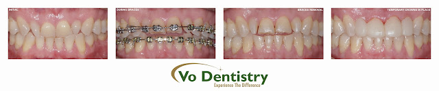 worn out dentition, teeth grinding, peg lateral,open bite, ceramic crowns, tooth color fillings, veneers, bite guard, Lawrenceville, Norcross, Lilburn, Dacula, buford, duluth, snellville, hamilton mill, grayson, sugar hill, sugar loaf, GA, Georgia, 30019, 30044, 30045