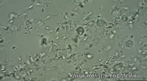 Aglutinasi Positif : Sperma Saling Menempel Aglutinasi Positif : Sperma Saling Menempel