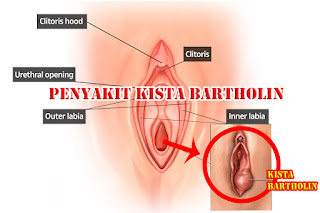 Cara Mengatasi Penyakit Kista Bartholin - Penyebab , Ciri , dan Mengatasinya