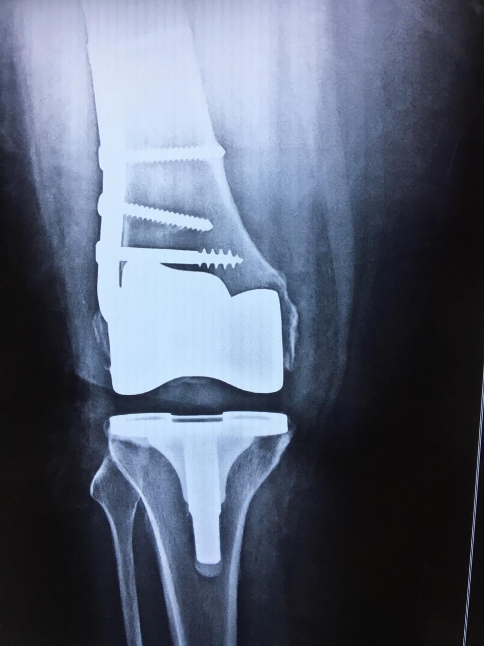 Total Knee Replacement with Fracture Plate
