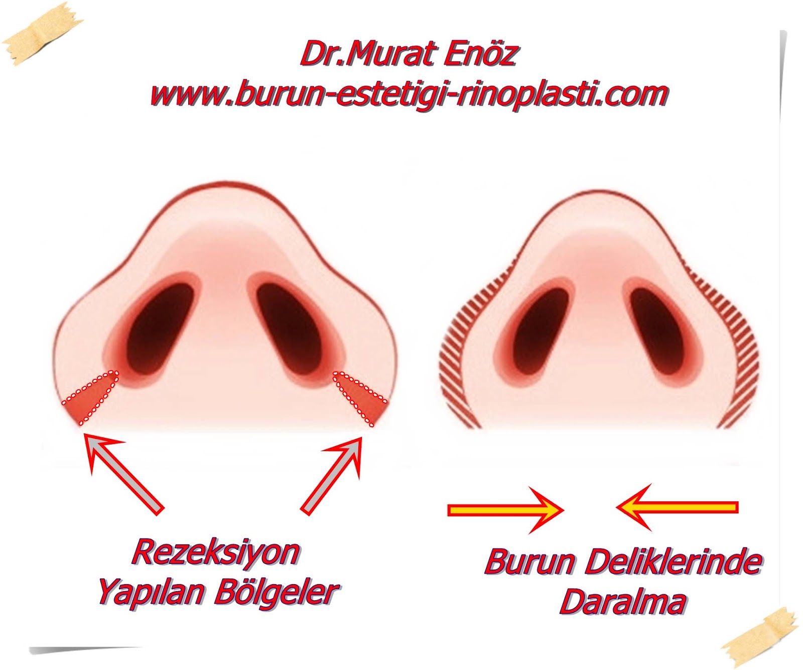 Health Zone Turkey Nose Wing and Nasal Holes Shrinkage Surgery Alar