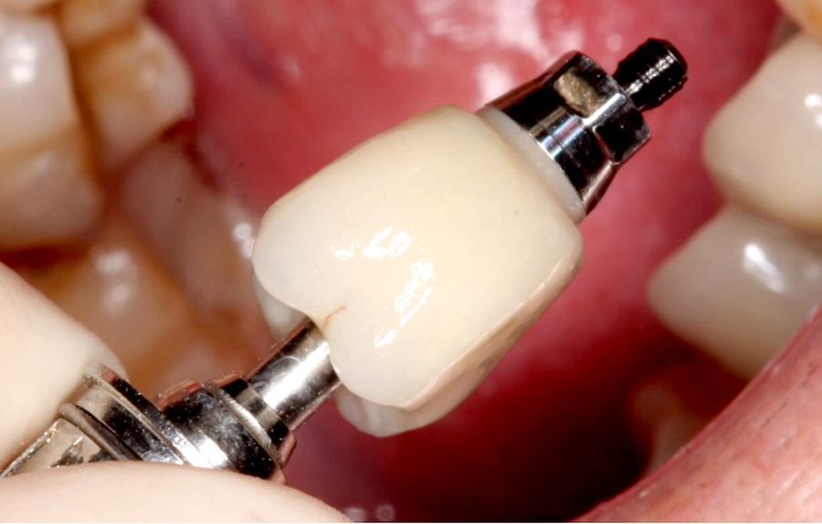 IMPLANTOLOGY Full Contour Zirconia Implant Crown Insert