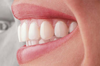 Chia sẻ thông tin các loại niềng răng không mắc cài Dsdsds%25C4%2591