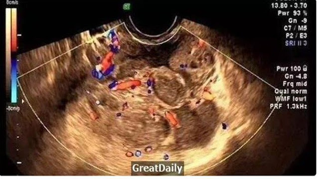 Perut Bayi 3 Tahun Ini Dipenuhi Nanah, Ternyata Kebiasaan Buruk Ibunya Saat Menyuapi Makanan, Bunda Boleh Share Perut Bayi 3 Tahun Ini Dipenuhi Nanah, Ternyata Kebiasaan Buruk Ibunya Saat Menyuapi Makanan, Bunda Boleh Share