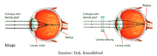 Materi Cahaya dan Optik Part 8 - Rabun Dekat dan Rabun Jauh - Wawan