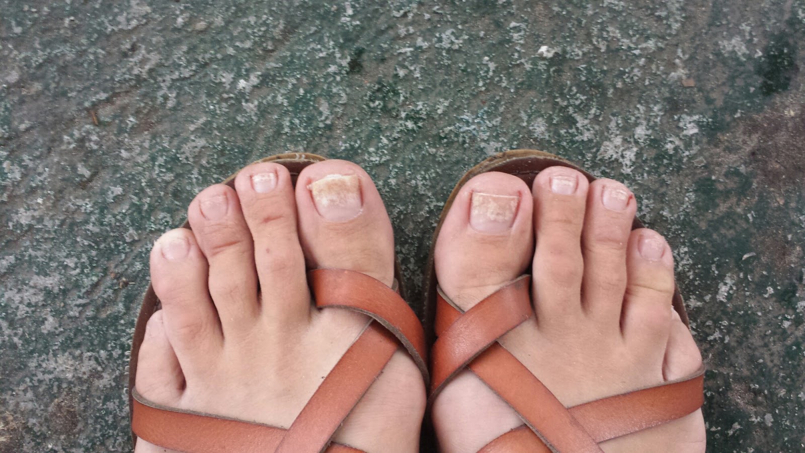 Get Rid of Brittle Toenails With Natural Home Remedies ToeNail Fungus