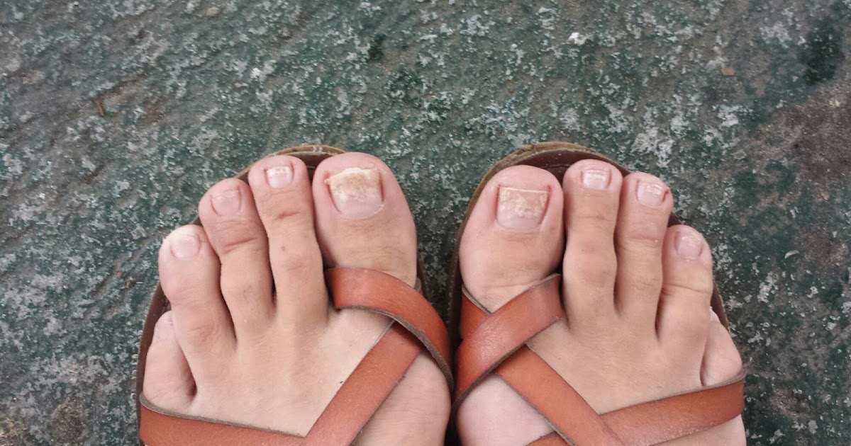 Get Rid of Brittle Toenails With Natural Home Remedies ToeNail Fungus