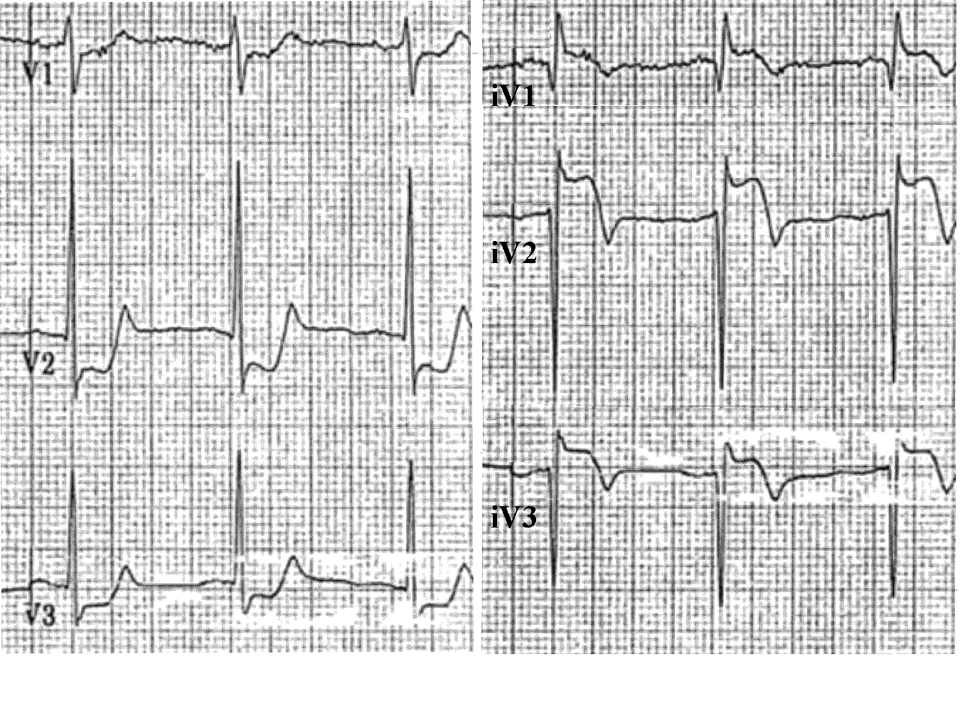 косонисходящая депрессия st. косонисходящая депрессия сегмента st. депрессия st на экг причины. экг при безболевой ишемии миокарда. косонисходящая депрессия st.