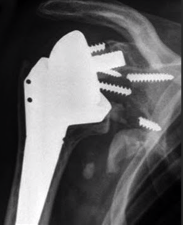 UW Shoulder and Elbow Academy The superior baseplate screw in reverse