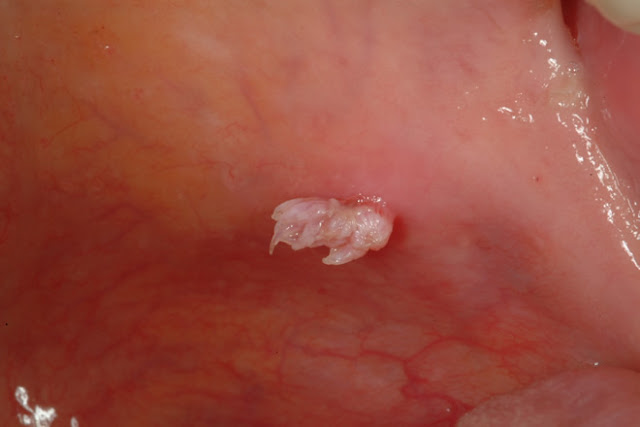 Papiloma escamoso palato mole Hpv treatment males,