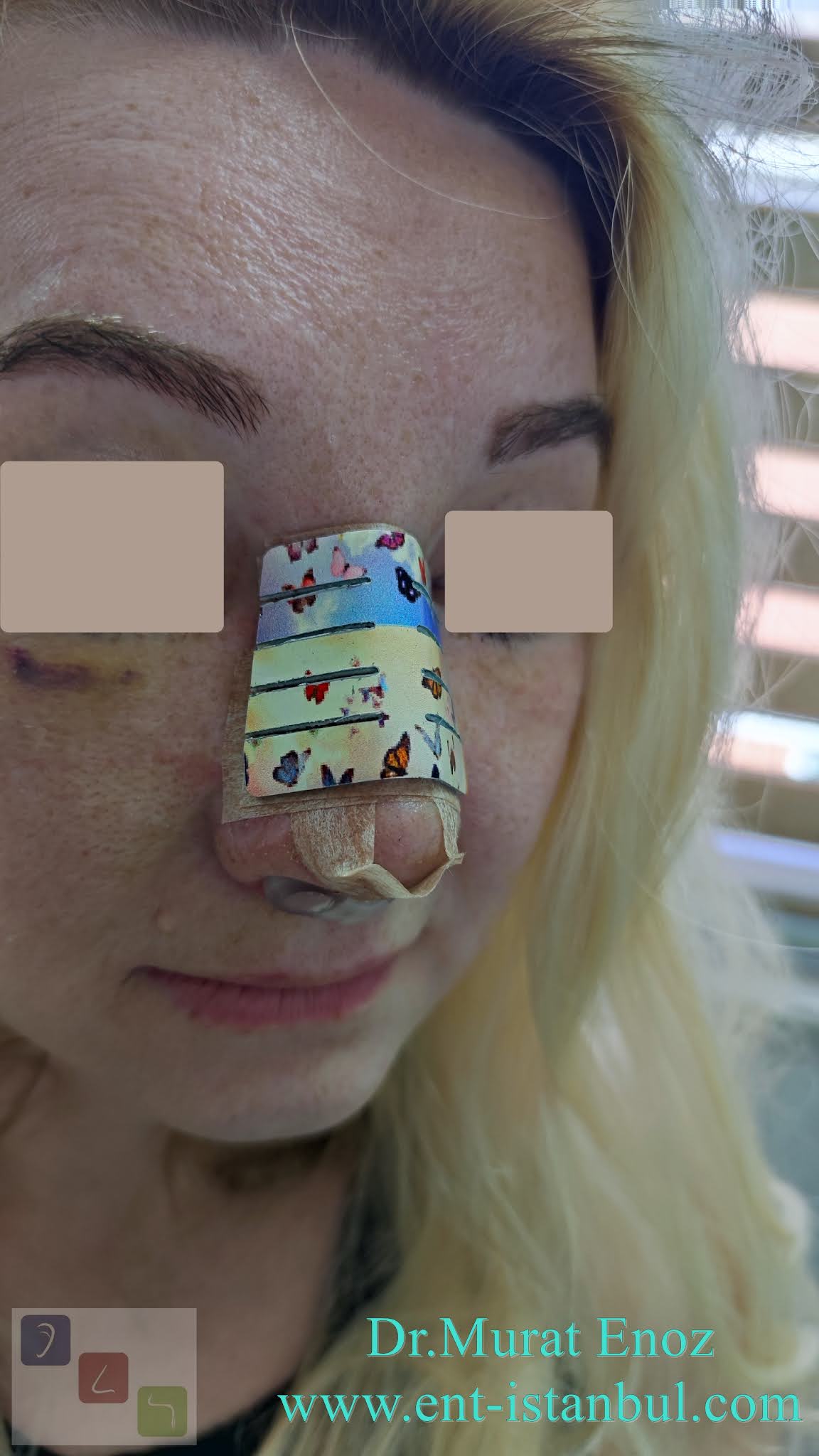 About The Nostril Retainer