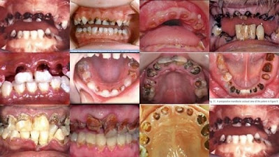 Răng sâu bị hôi bạn nên điều trị ngay tại nha khoa-1