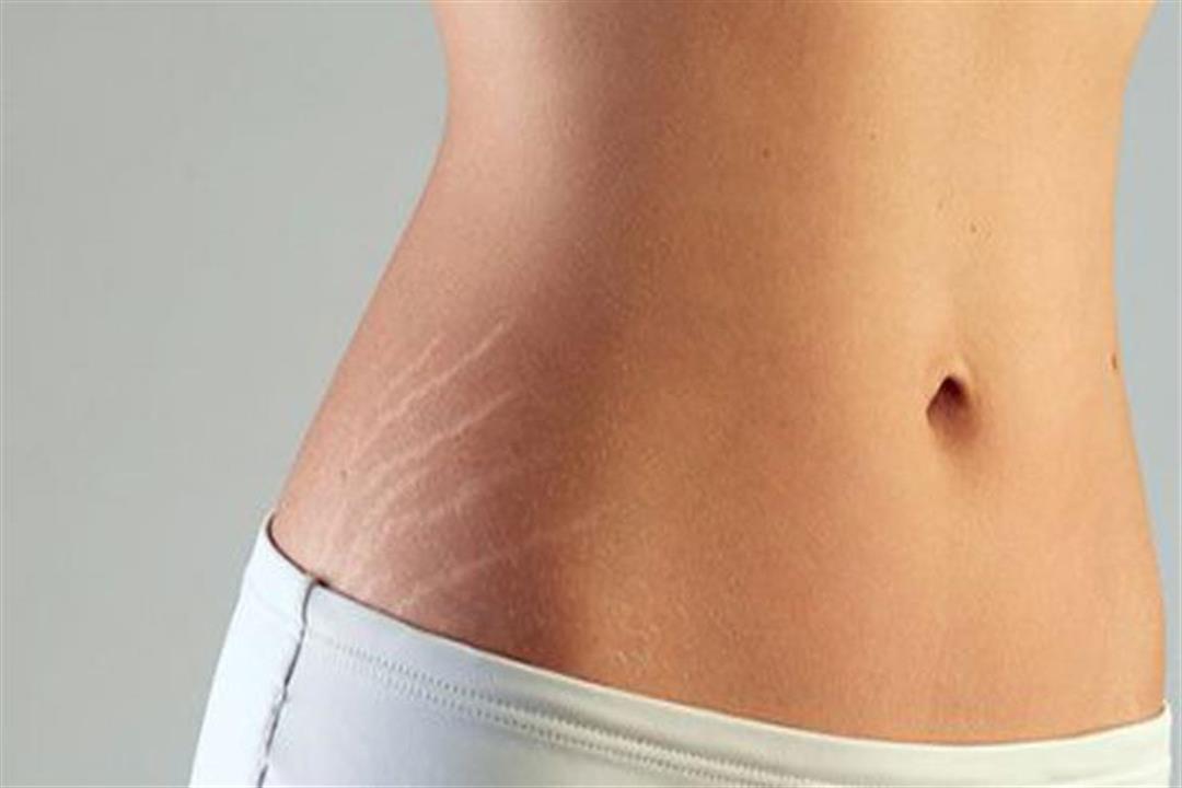 نصائح هامة للتخلص من علامات التمدد في فترة الحمل عشق الحياة