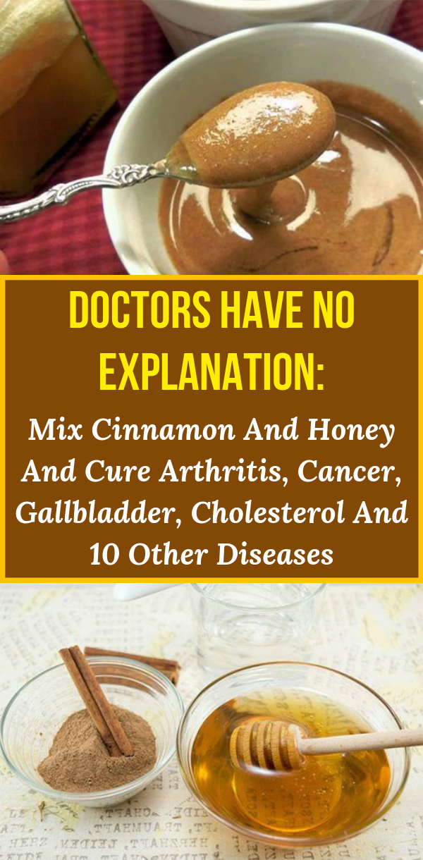 Doctors Have No Explanation Mix Cinnamon And Honey And Cure Arthritis