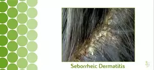 scalp buildup scalp buildup