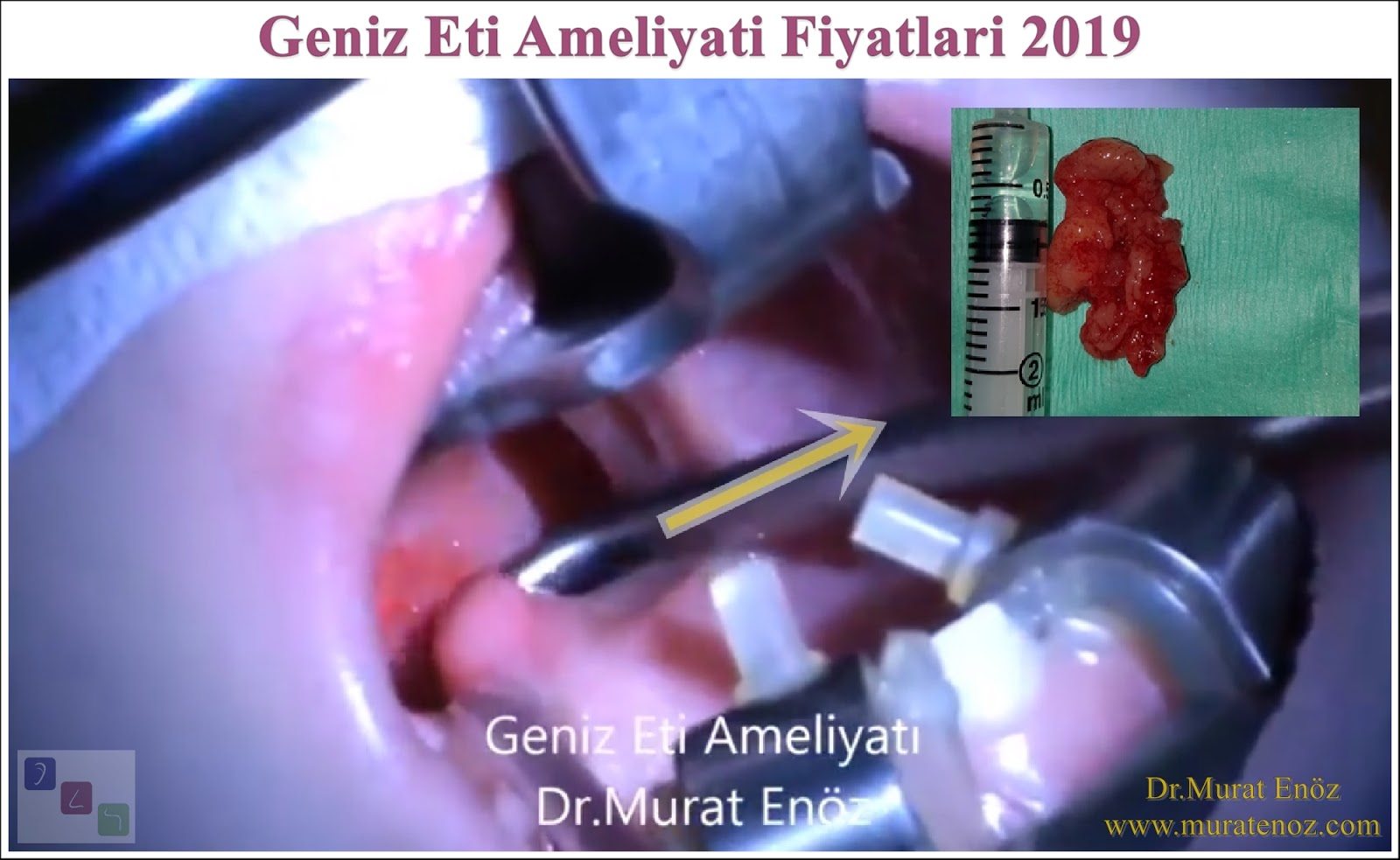 Geniz Eti Ameliyatı Fiyatları 2019