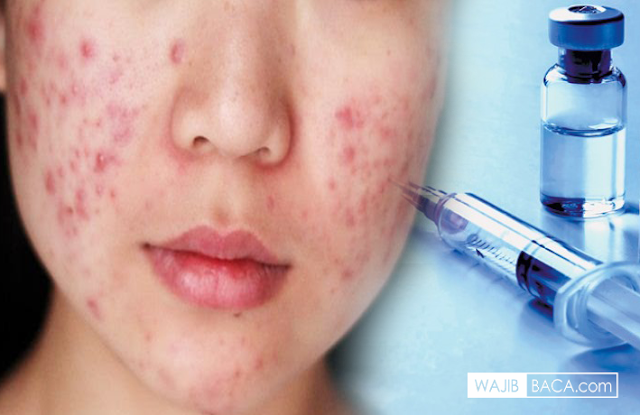 Kabar Baik Bagi Kamu yang Jerawatan, Kini ada Terobosan Baru Vaksin Anti Jerawat Kabar Baik Bagi Kamu yang Jerawatan, Kini ada Terobosan Baru Vaksin Anti Jerawat