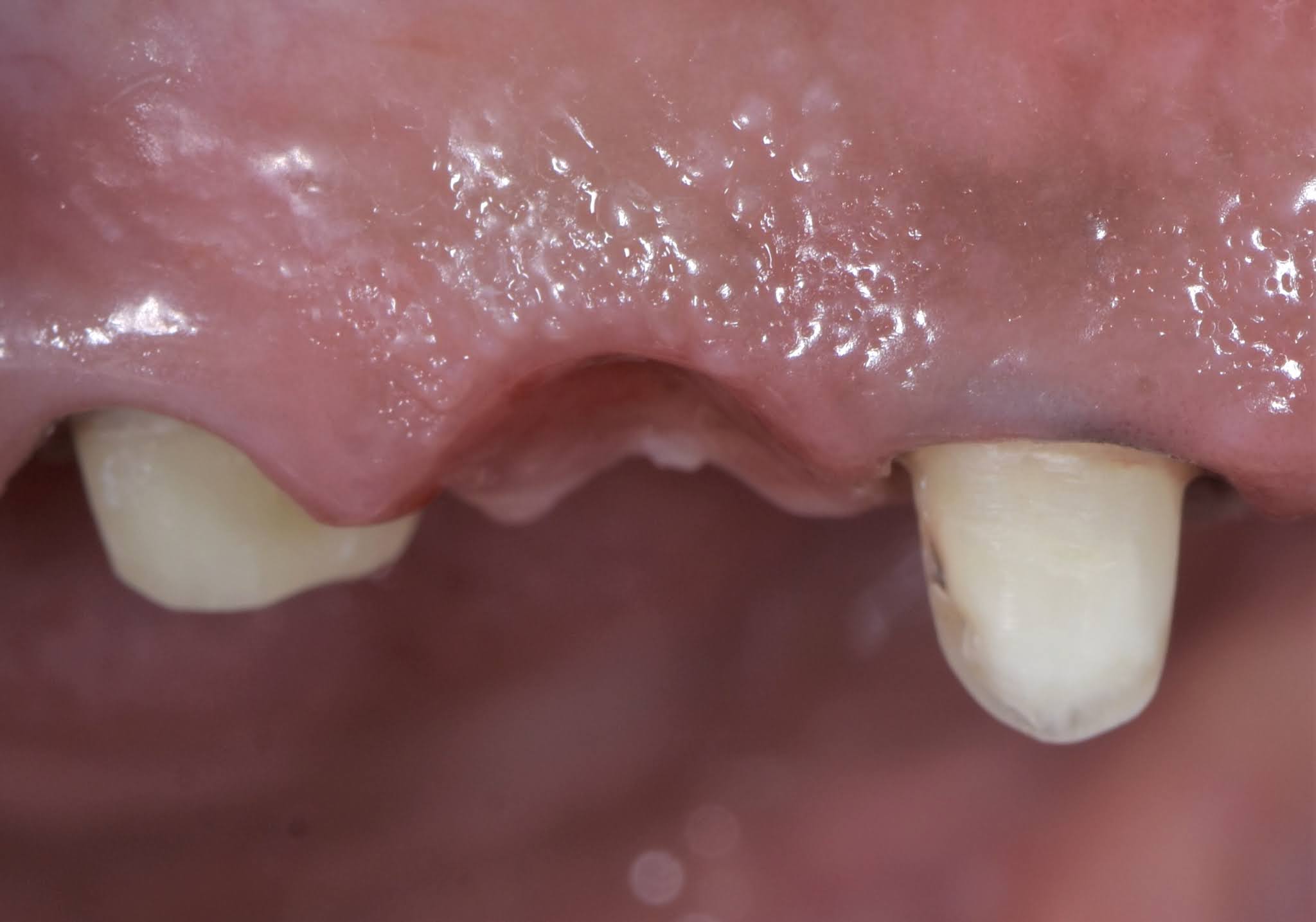 Dental Esthetics Ovate pontic for the correct emergence profile.. A clinical case