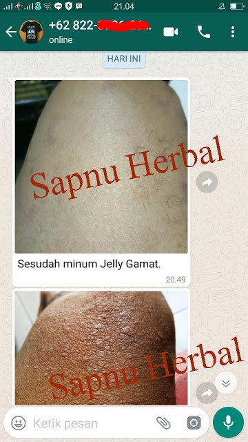 Cara Menghilangkan Bintik Merah Seperti Jerawat Di Kulit Perut Terbukti Mujarab ~ TESTIMONI QNC JELLY GAMAT Cara Menghilangkan Bintik Merah Seperti Jerawat Di Kulit Perut Terbukti Mujarab ~ TESTIMONI QNC JELLY GAMAT