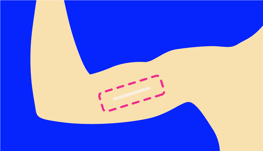 Health Zone Turkey What is a Subcutaneous Implant (Birth Control Stick)?