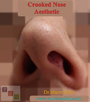 Twisted Nose Rhinoplasty,Crooked Nose Aesthetic Surgery in Istanbul,