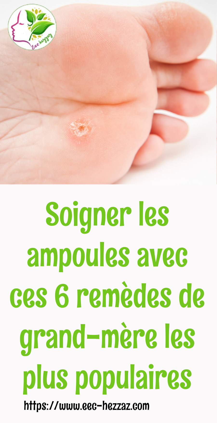 Soigner les ampoules avec ces 6 remèdes de grand-mère les plus populaires