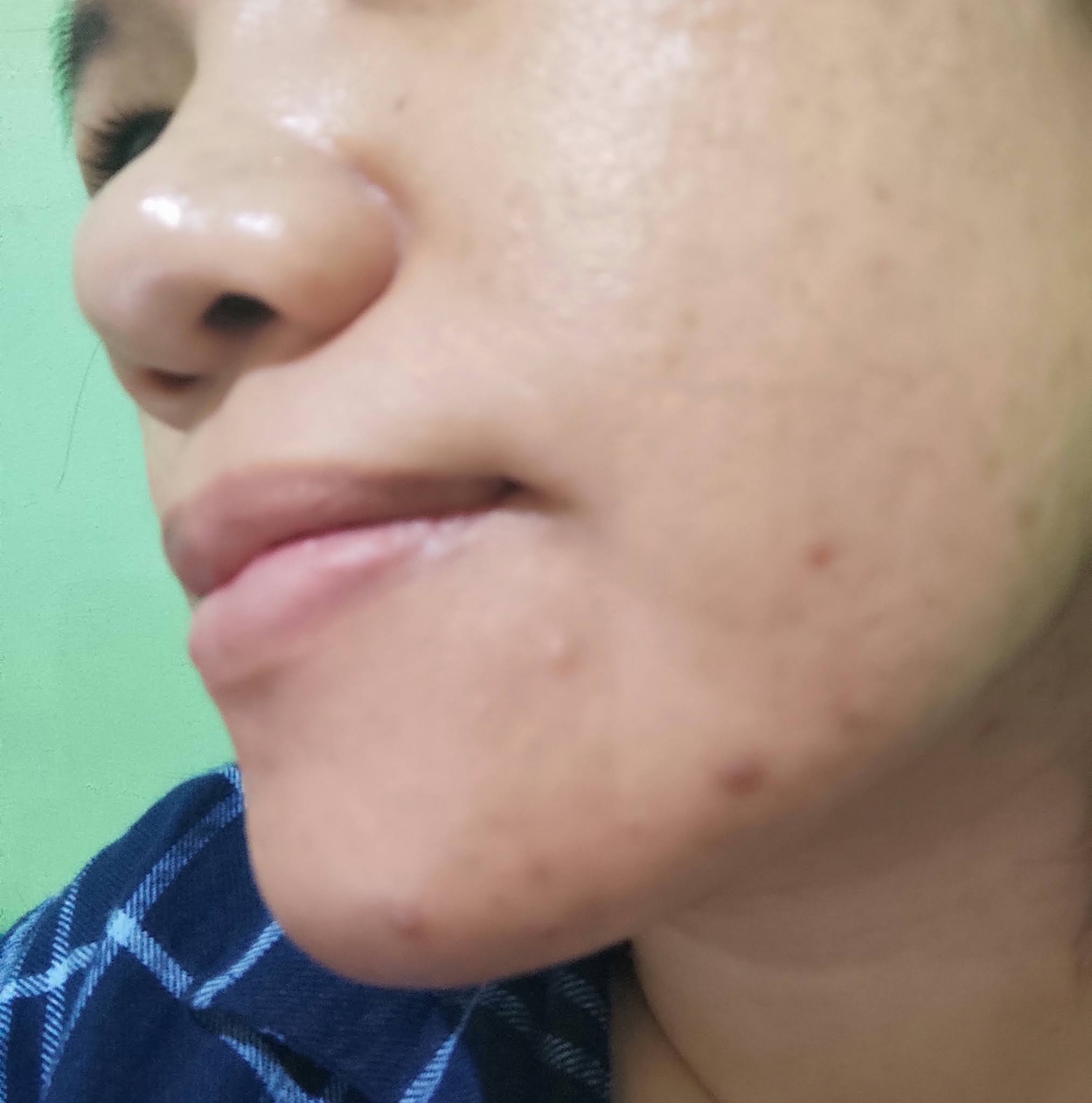 Pengalaman Perawatan Di Dokter Kulit Dan Kelamin Kecantikan