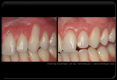 récession gingivale