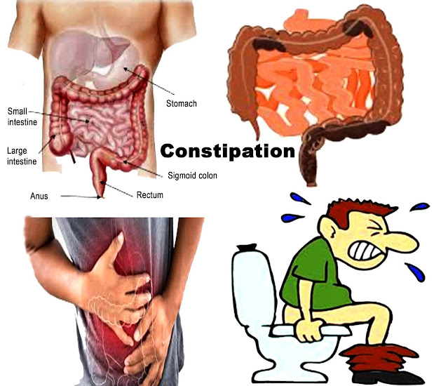 Constipation Symptoms Causes Prevention and Treatment 
