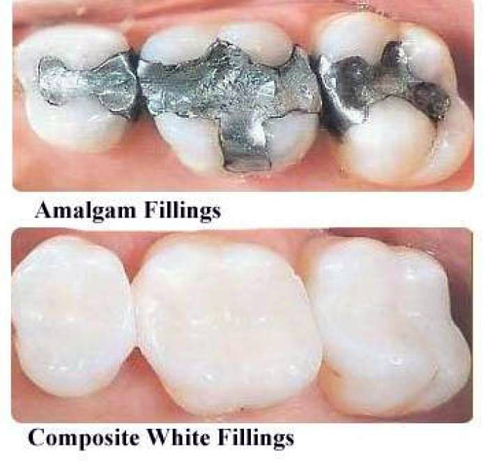 How To Make Tooth Filling Filler Prices Turkey