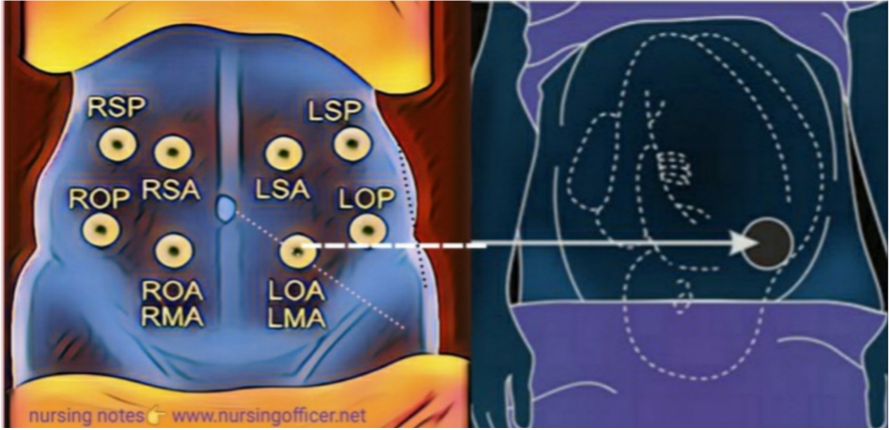 fetal heart sound auscultation site Mr SHYAM