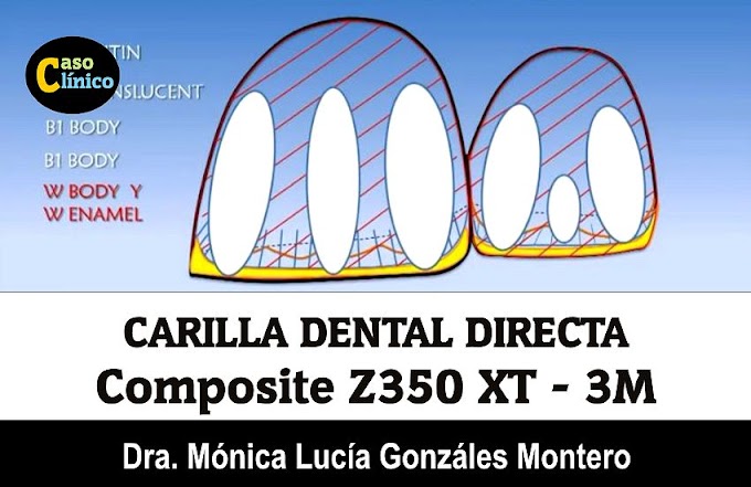 CARILLA DENTAL: Con Composite Z350 XT - Dra. Mónica Lucía Gonzáles Montero