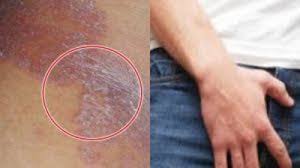 nama obat gatal yang ampuh gatal pantat atau bokong nama obat gatal yang ampuh gatal pantat atau bokong