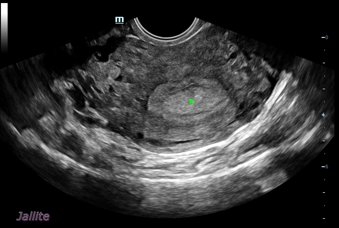 Pólipo Endometrial
