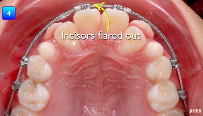 CLINICAL CASE: Bilaterally U2-U3 Transposition in Early mixed Dentitons