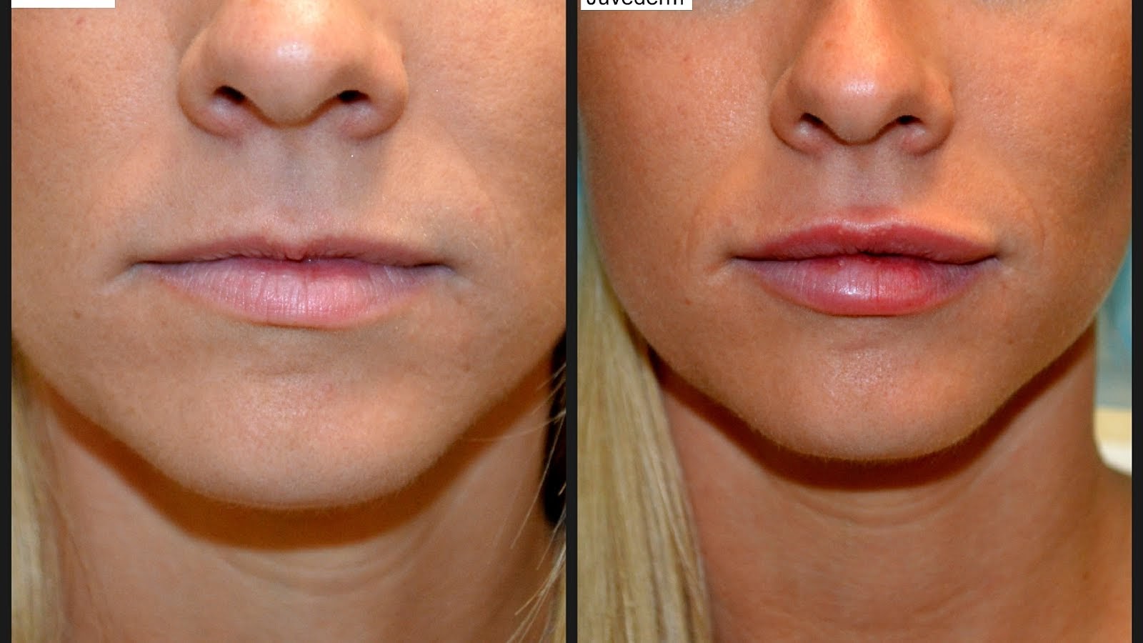 Juvederm Side Effects Lips Effect Choices