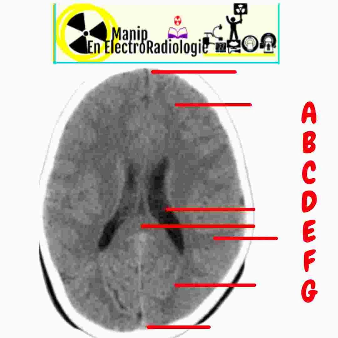 Structures anatomiques du tdm cérébral normal au niveau du ventricule latéral