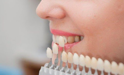  Tẩy trắng răng có mấy phương pháp