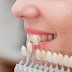  Tẩy trắng răng có mấy phương pháp