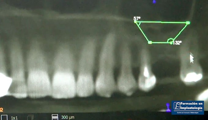 ELEVACIÓN SUELO SINUSAL: Hueso autógeno de rama mandibular