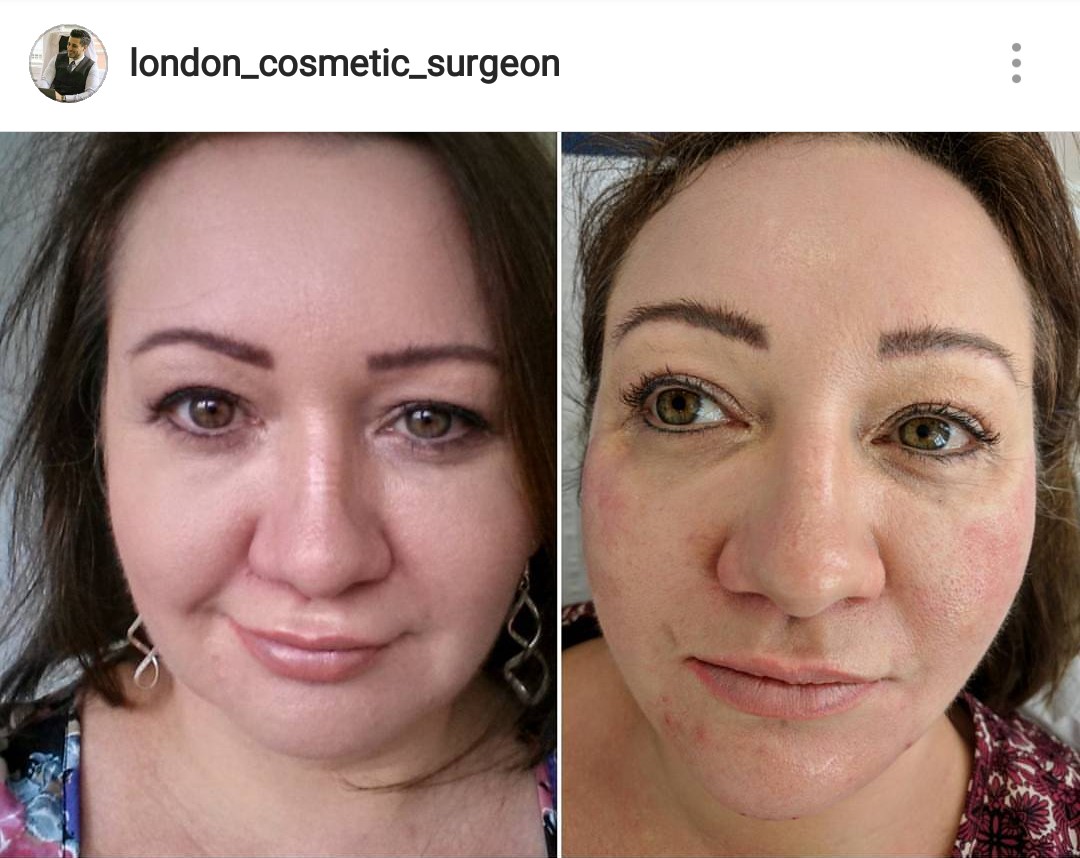 Before & After Chin & Cheek Fillers with Dr Deniz
