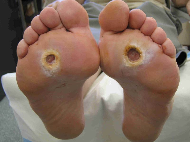 @ Diabetic Foot Ulcer Pictures - diabetes cure by food