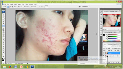 Tips Menghilangkan Jerawat Menggunakan Photoshop