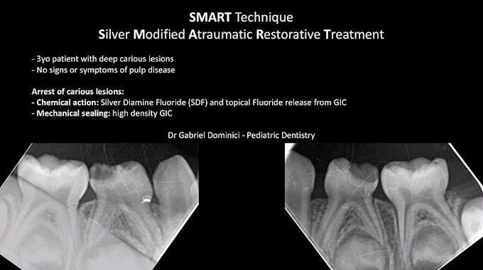 SMART Technique: Caries stabilization - Dr. Gabriel Dominici
