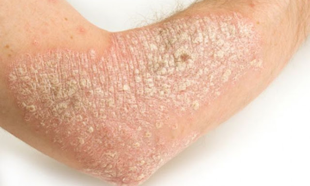 macam-macam jenis penyakit kulit dan cara mengatasinya