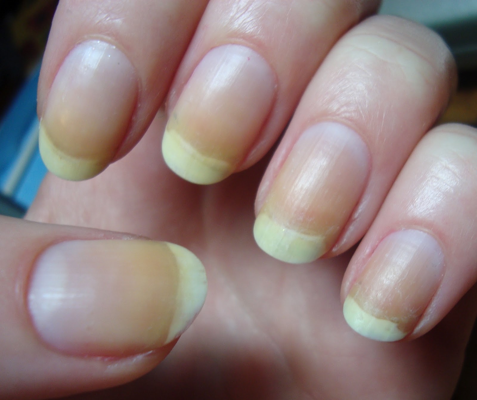 Black lines in fingernails | Skin Conditions discussions ...